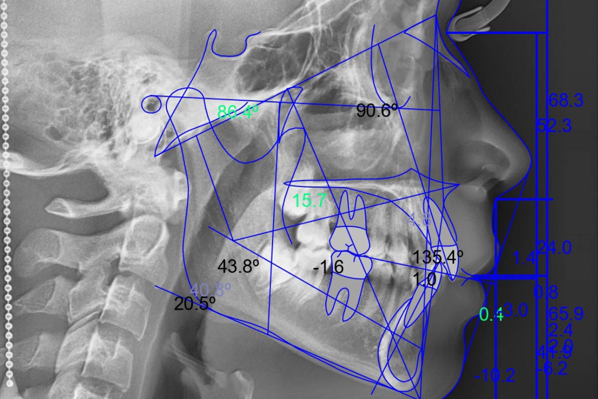 analisis cefalometrico